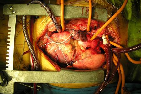 Cardio surgery, illutsrative stock photo.