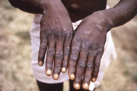 As more cases of monkeypox are detected in Europe and North America in 2022, some scientists who have monitored numerous outbreaks in Africa say they are baffled by the unusual disease's spread in developed countries. 