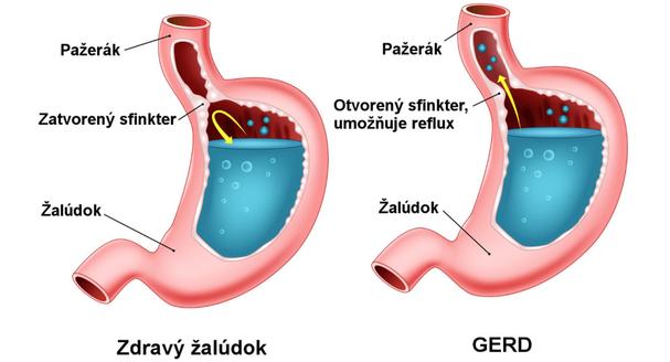 Obr. 4: Pažeráková refluxná choroba sa zvykne označovať aj skratkou GERD. Vysvetlenie v texte. Zdroj: https://zdravovek.eu/reflux/
