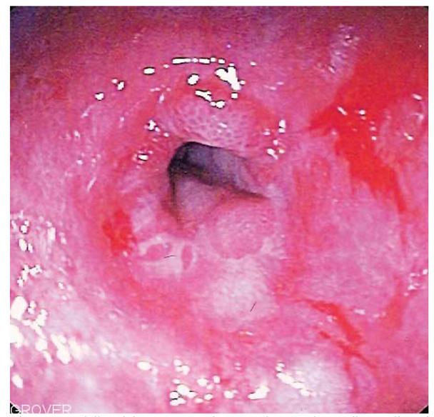 Obr. 5: Skúsený špecialista dokáže s presnosťou, rovnajúcou sa istote, diagnostikovať GERD endoskopickým vyšetrením. Ilustračné foto, zdroj:
https://www.britannica.com/science/gastroesophageal-reflux-disease