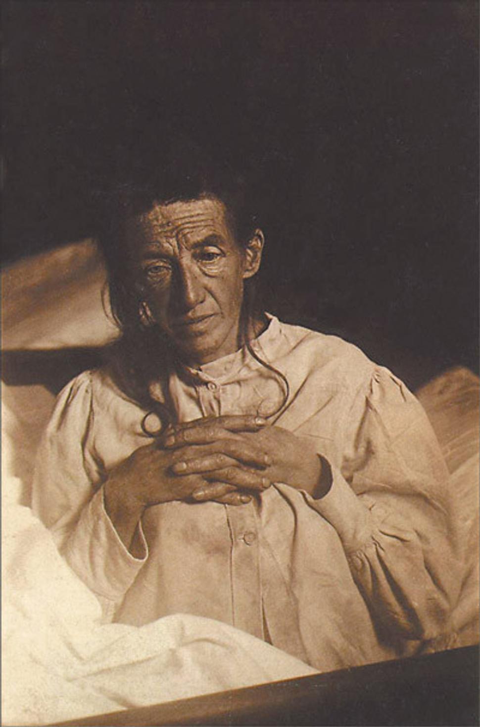 Auguste Deter, slávna Alzheimerova pacientka.