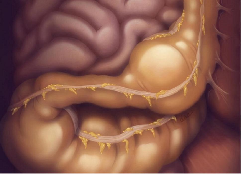 Obr. 5: Obstipácia vyprovokovaná opioidmi. Zdroj: https://www.clinicalpainadvisor.com/home/topics/chronic-pain/opioid-induced-constipation-insights-into-diagnosis-and-effective-treatment/