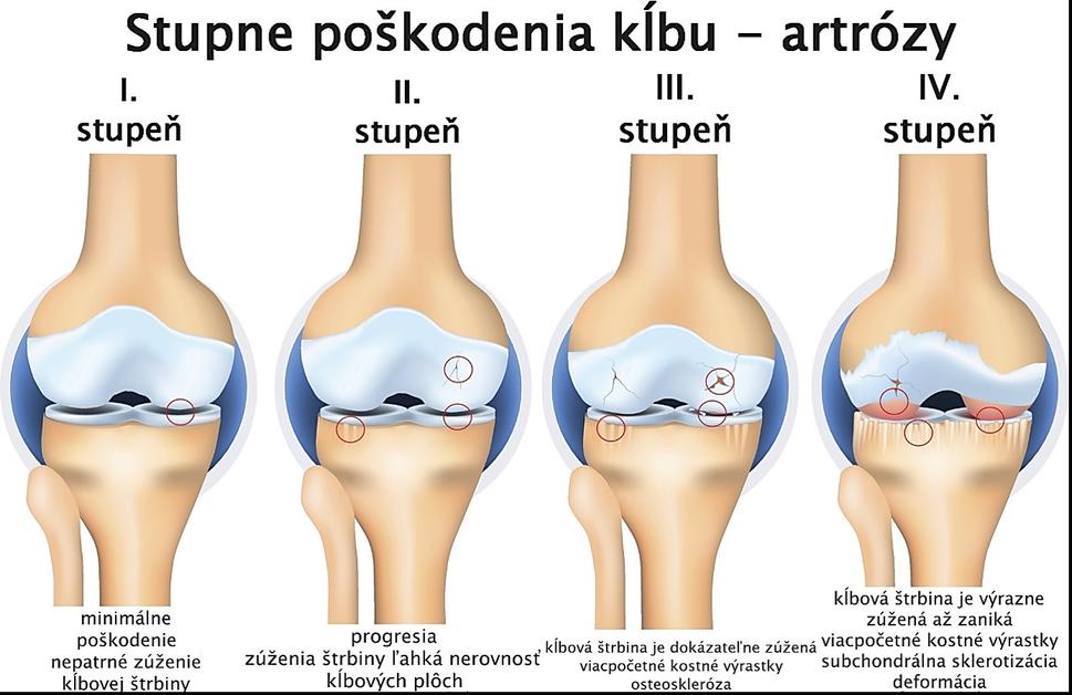 Obr. 3: Na príklade kolenného kĺbu sú znázornené stupne artróz od najľahšej po najťažšiu.
Zdroj: https://zdravoteka.sk/choroby/artroza/