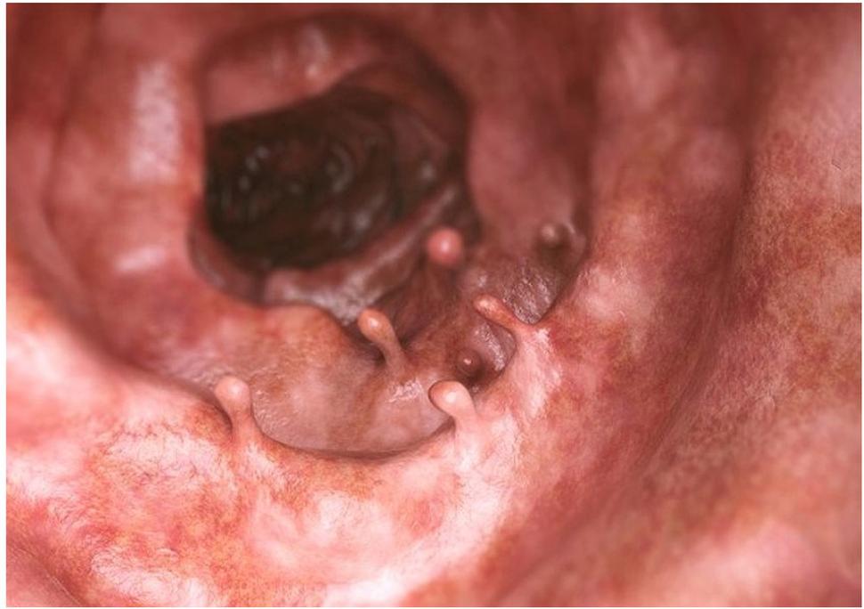 Obr. 3: Endoskopický (kolonoskopický) obraz polypov hrubého čreva. Zdroj:
https://vysetrenie.zoznam.sk/cl/1000649/1797491/Gastroenterolog-Rudolf-Hrcka--Az-patina-ludi-nad-50-ma-v-hrubom-creve-aspon-jeden-polyp