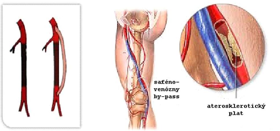 Obr.6: Naloženie premostenia (by pass) sklerotickým procesom upchatej tepny pomocou štepu z povrchovej žily dolnej končatiny. Zdroj: https://www.domzdraviajuh.sk/ambulancie/angiologicka-ambulancia/tepnove-ochorenia/periferne-arteriove-ochorenie/