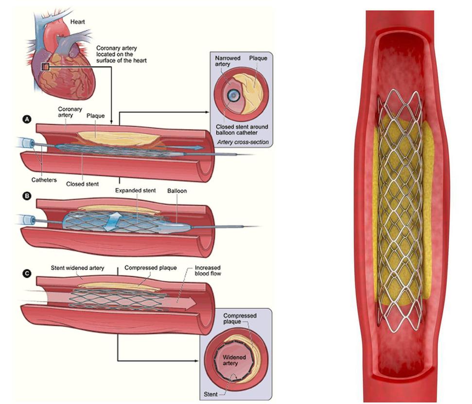 Obr. 7: Naloženie stentu dokáže plnohodnotne spriechodniť sklerotickým procesom postihnutú artériu. Zdroje: https://cs.wikipedia.org/wiki/Stent#/media/Soubor:PTCA_stent_NIH.gif https://poprostuzdrowo.pl/stent