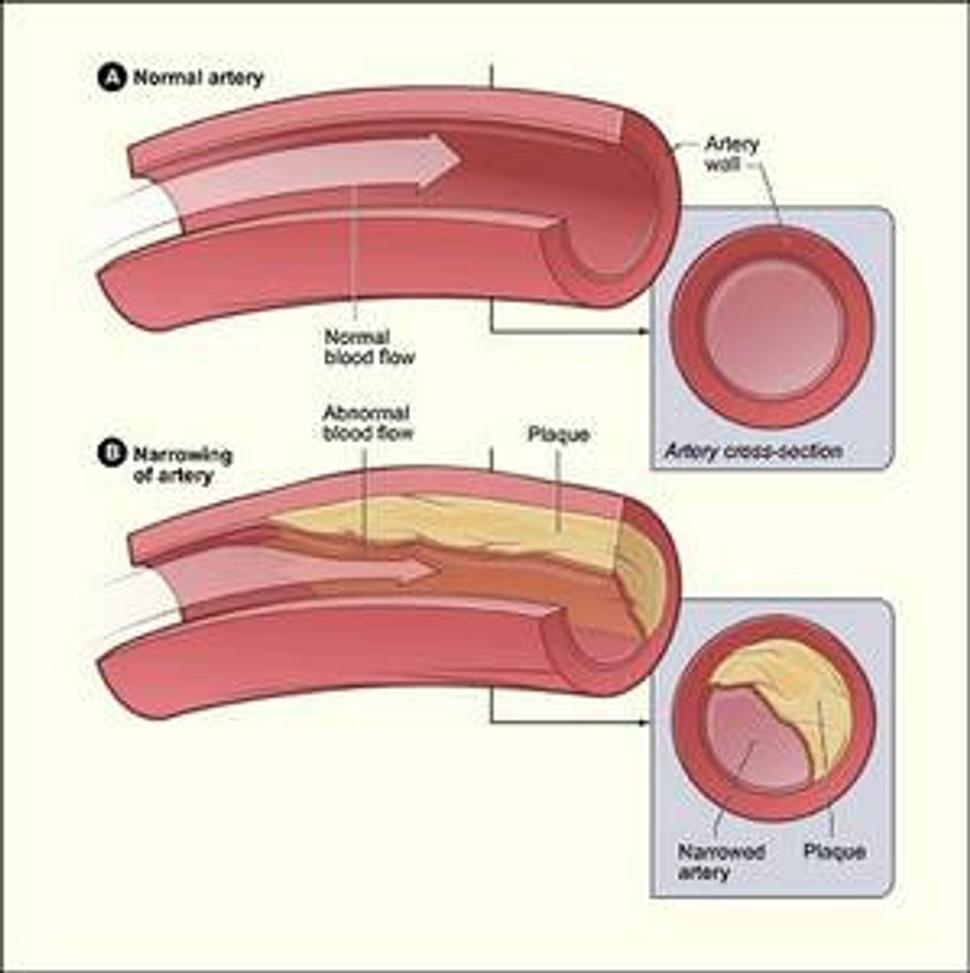 zdravé cievy vs. poškodené cievy vplyvom zoxidovaného cholesterolu