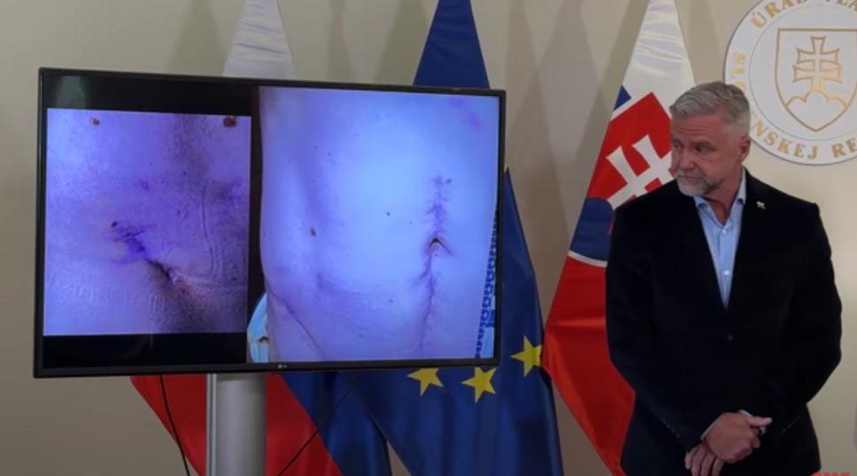 Zjavne ide o to isté telo (materinské znamienka na obidvoch snímkach). Kedy a prečo a boli snímky zhotovené a čo nám tým chce Tibor Gašpar povedať, to sa opýtajte jeho. Prípadne Brucha, ten vie údajne na každého niečo