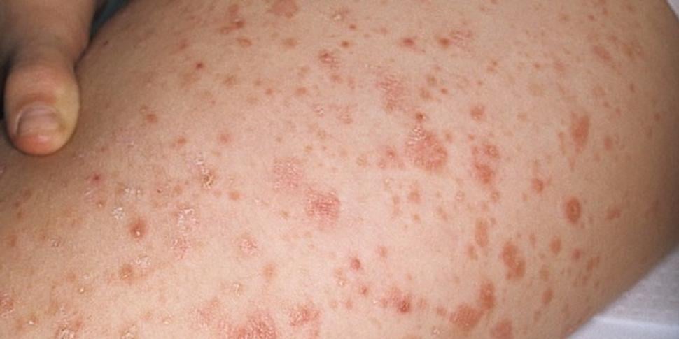 psoriáza