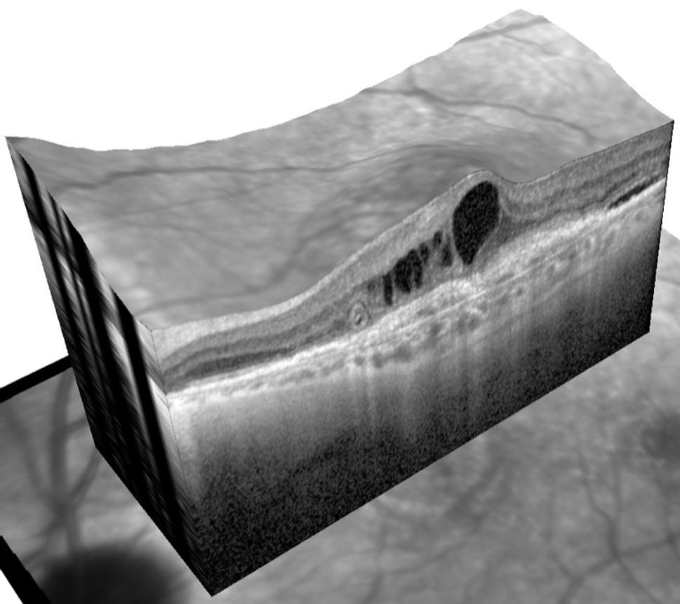 To isté ale zobrazené prístrojom OCT ako 3D model. V tejto kvalite sme dnes schopní zobraziť sietnicu. Hrúbka v strede je cca 0,4 mm.