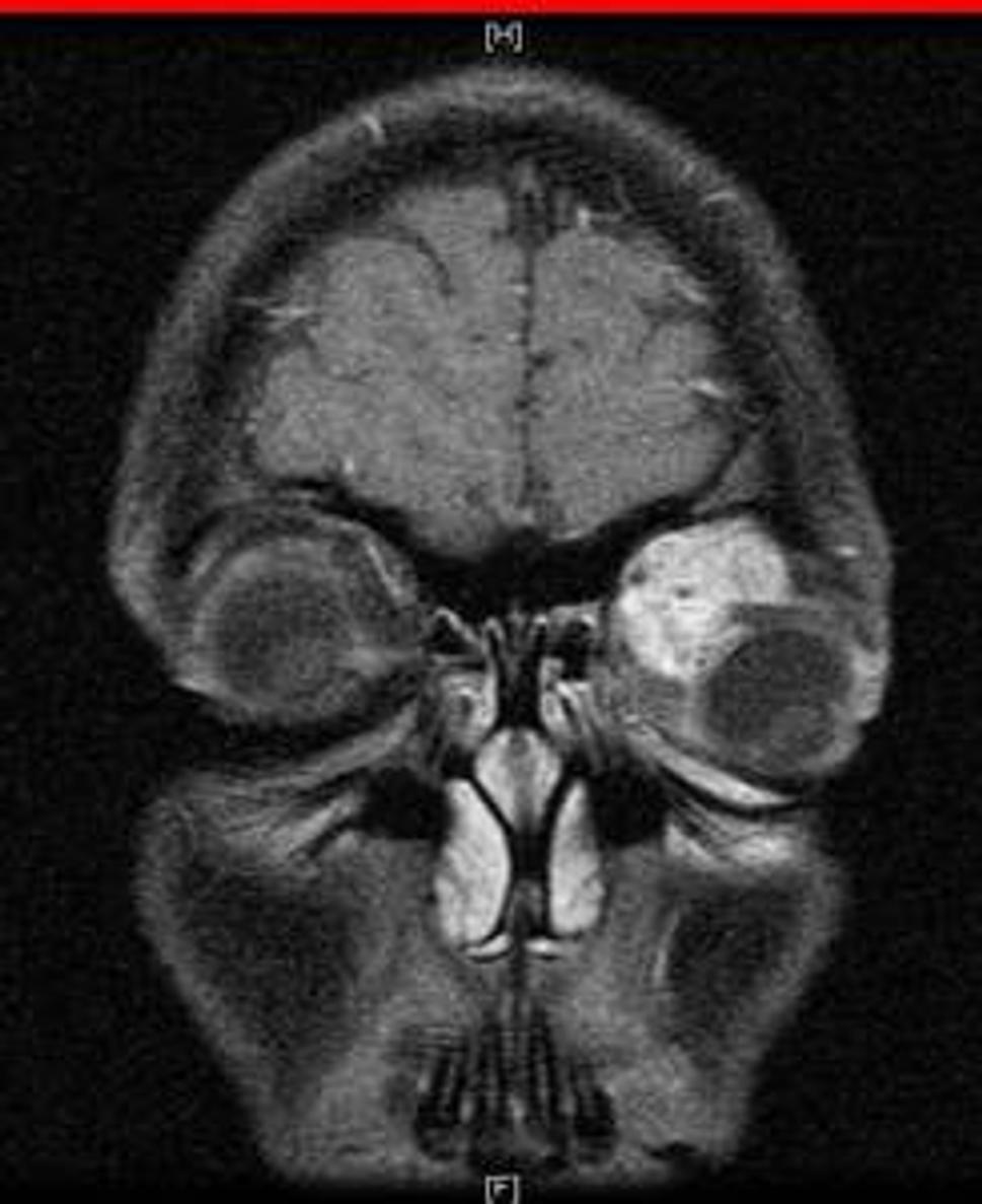 MR, rabdomyosarcoma