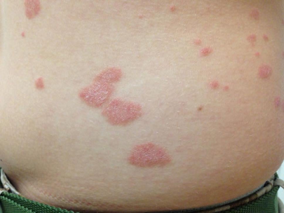 psoriáza