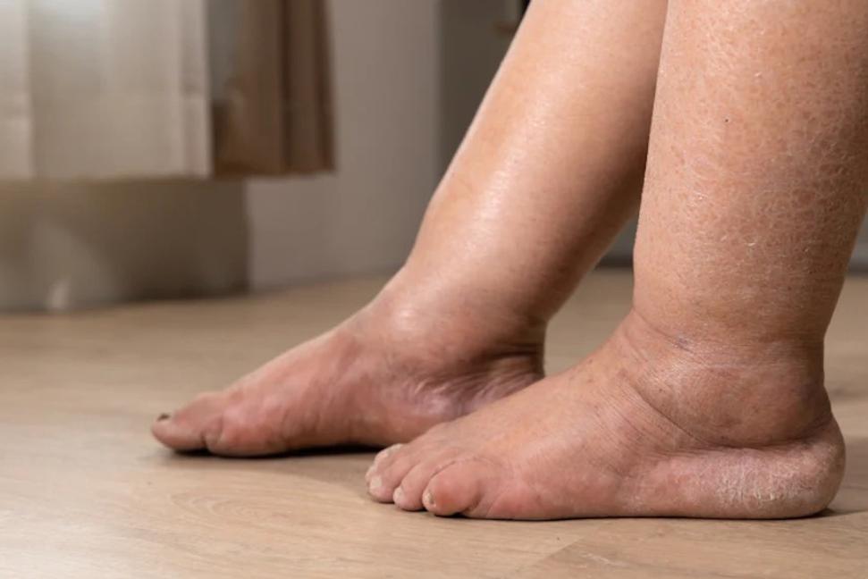 Opuchnuté nohy v lete? Tu sú rady, ako ich zmierniť a predísť problémom